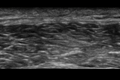 muscle_sonosite-1024x503