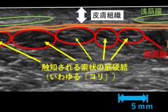 muscle_sonosite3-1024x519