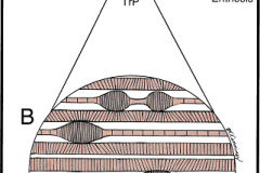 taut_band_and_nodule